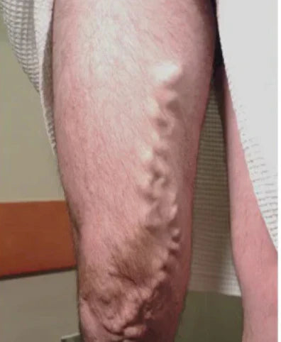 AQA™ VeinEase Microneedle Therapy Patch